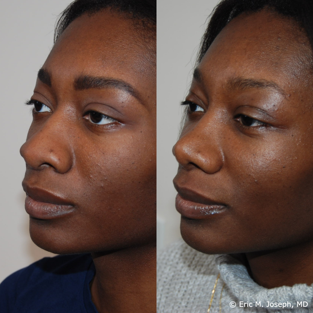 rhinoplasty-specialist-nj-0830.png
