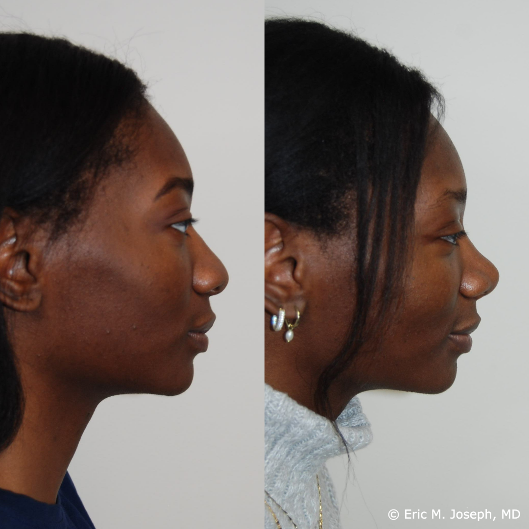 rhinoplasty-specialist-nj-0831.png