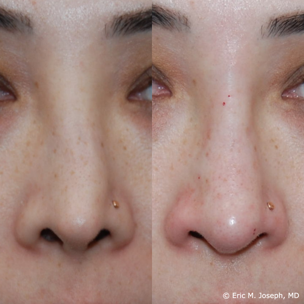 Eric M. Joseph, MD | Permanent Non Surgical Rhinoplasty/ Nose Job