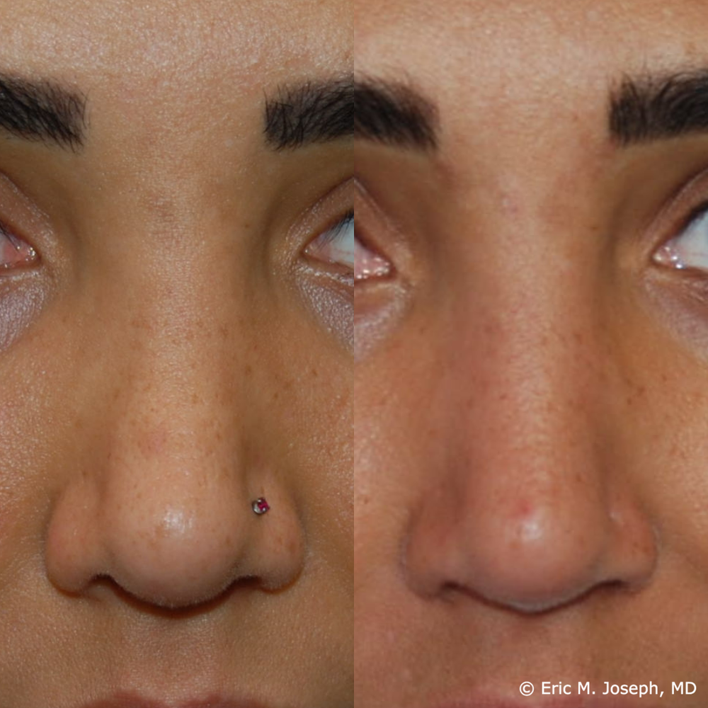 Eric M. Joseph, MD | Permanent Non Surgical Rhinoplasty/ Nose Job