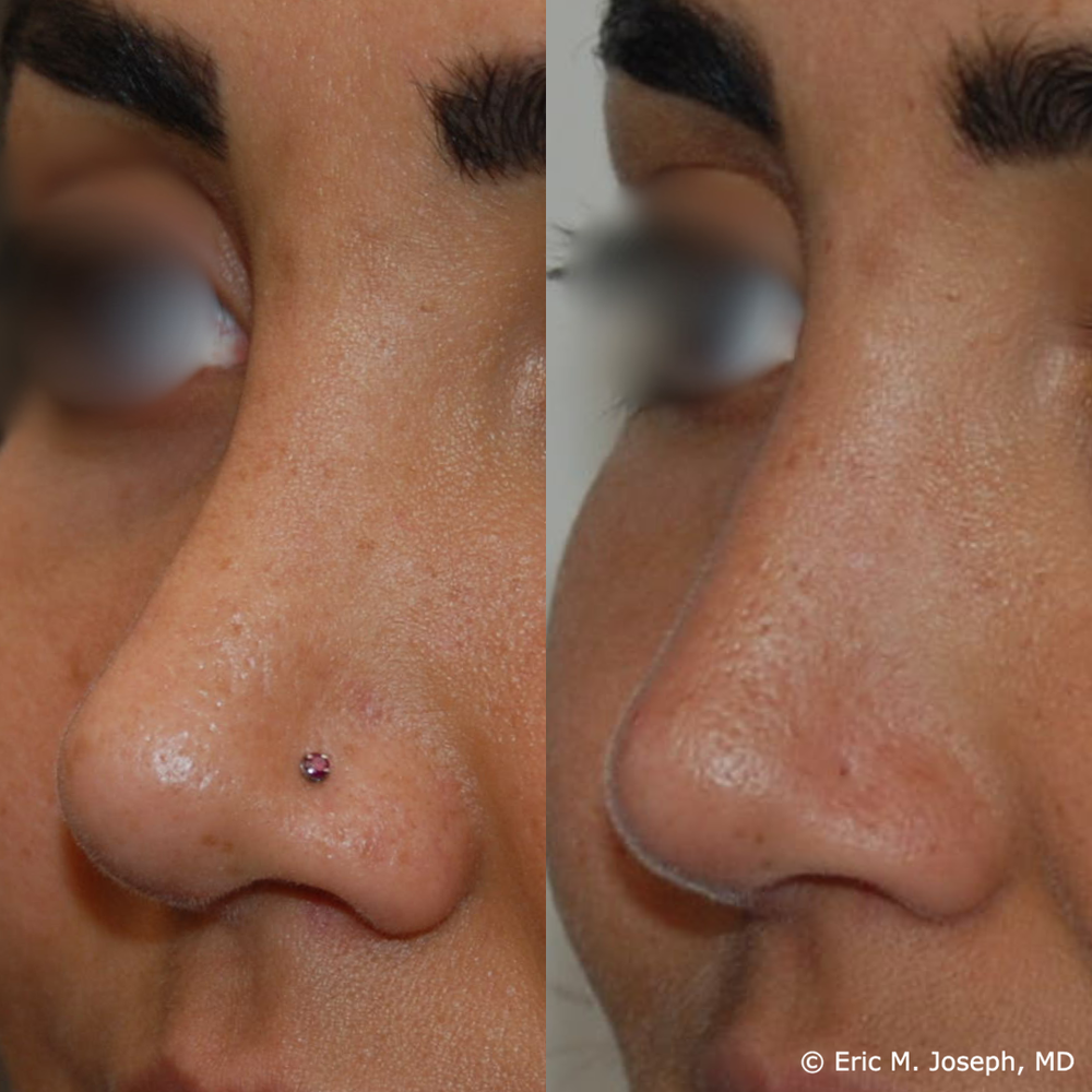 Eric M. Joseph, MD | Non-Surgical Rhinoplasty Before & After
