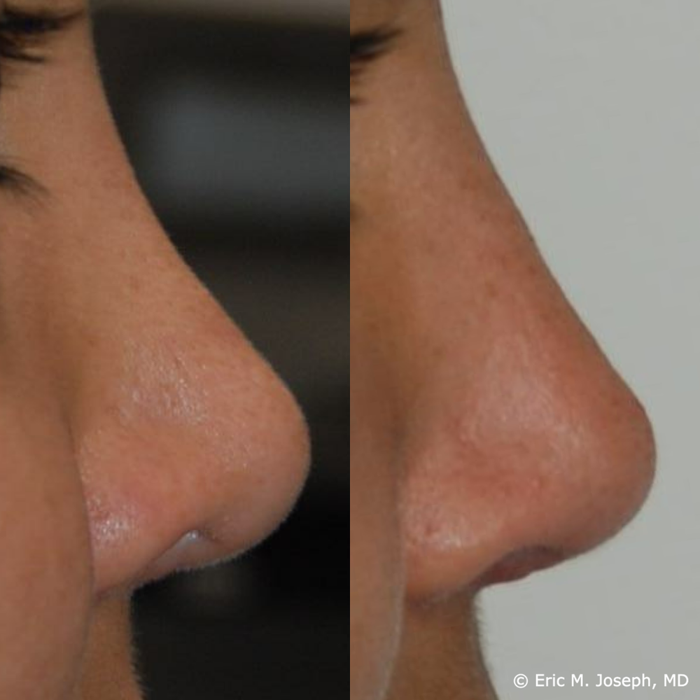 Non-surgical rhinoplasty — Eric M. Joseph, MD | Permanent Non