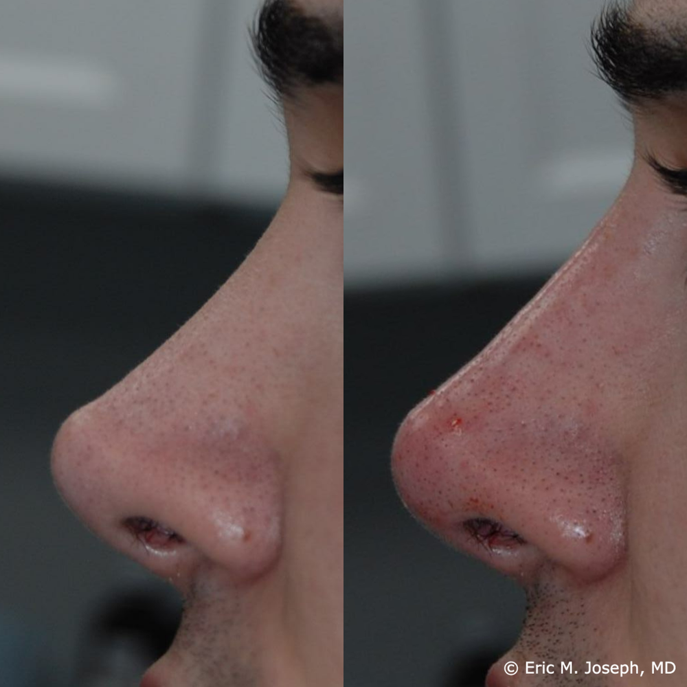Non-surgical rhinoplasty — Eric M. Joseph, MD | Permanent Non