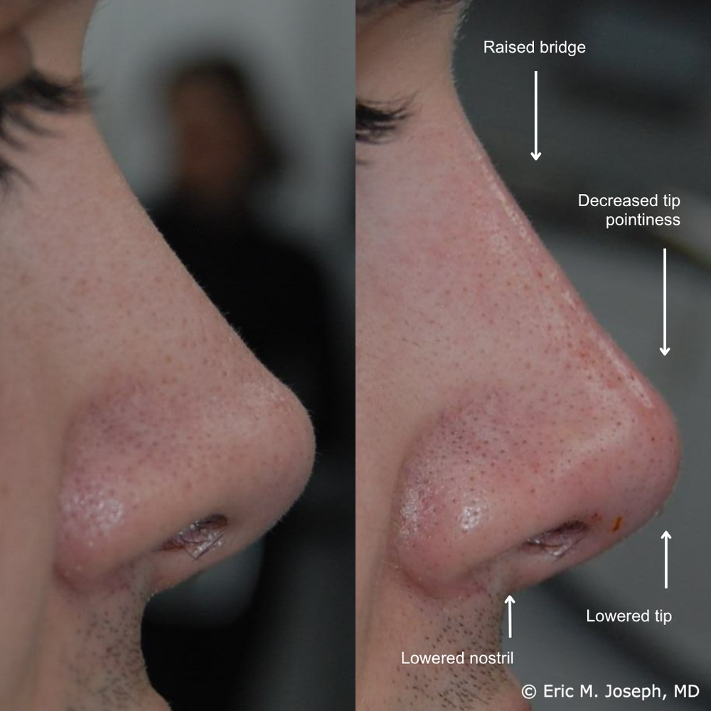 Non-Surgical Rhinoplasty — Eric M. Joseph, MD | Permanent Non