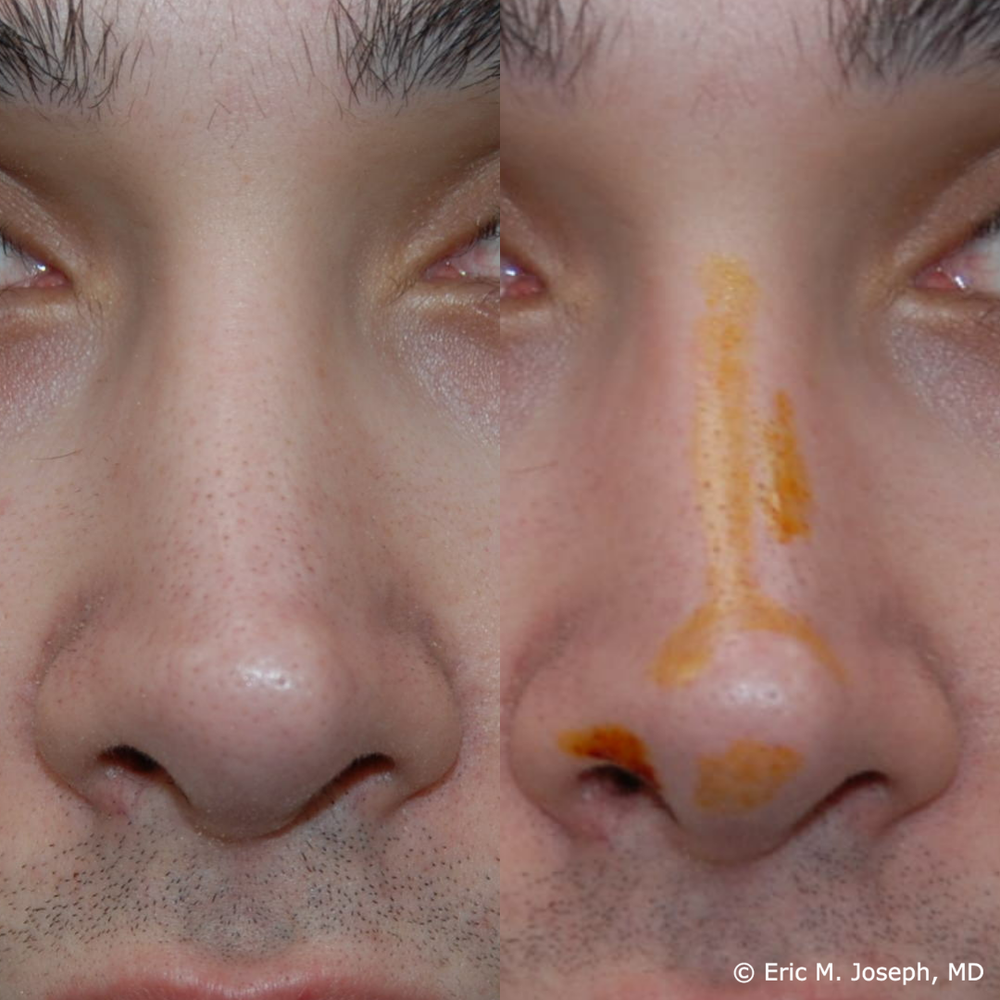 Eric M. Joseph, MD | Permanent Non Surgical Rhinoplasty/ Nose Job
