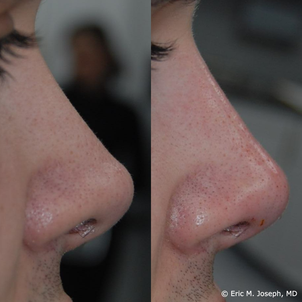 Eric M. Joseph, MD | Permanent Non Surgical Rhinoplasty/ Nose Job