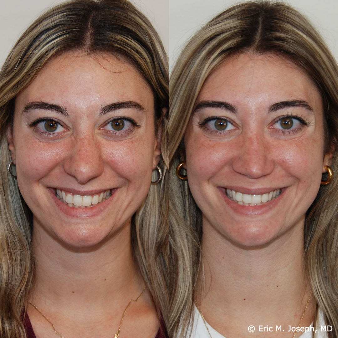 revision-rhinoplasty-nj-1020.png