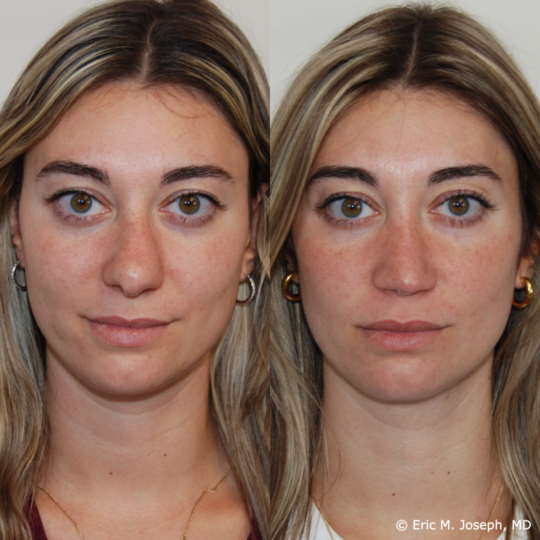 revision-rhinoplasty-nj-1021.png