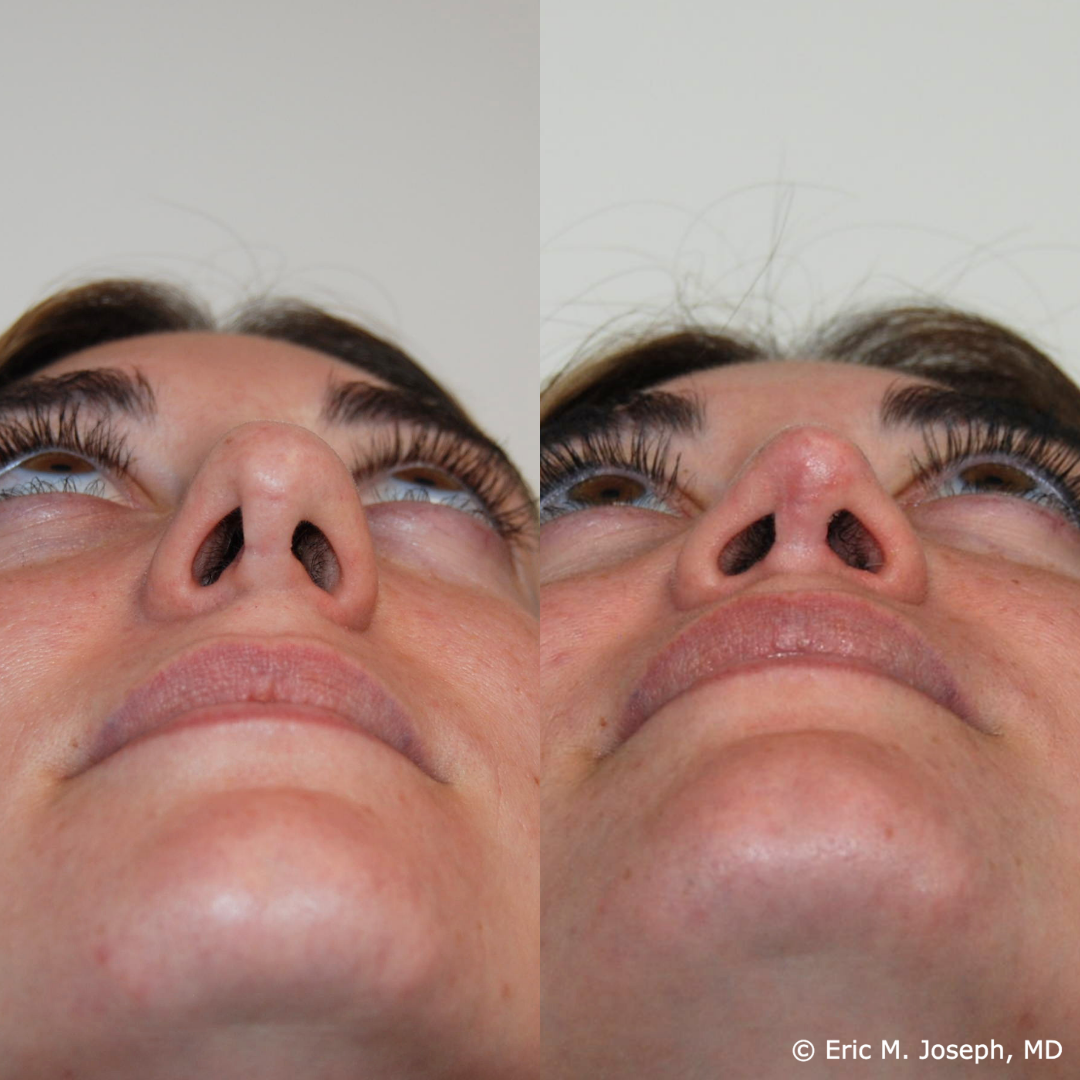 revision-rhinoplasty-nj-1022.png