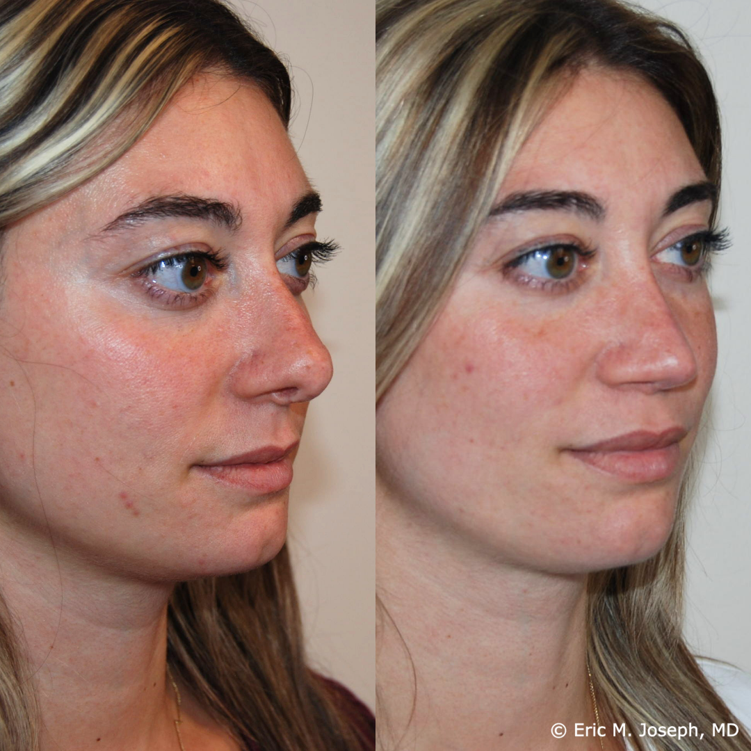 revision-rhinoplasty-nj-1023.png