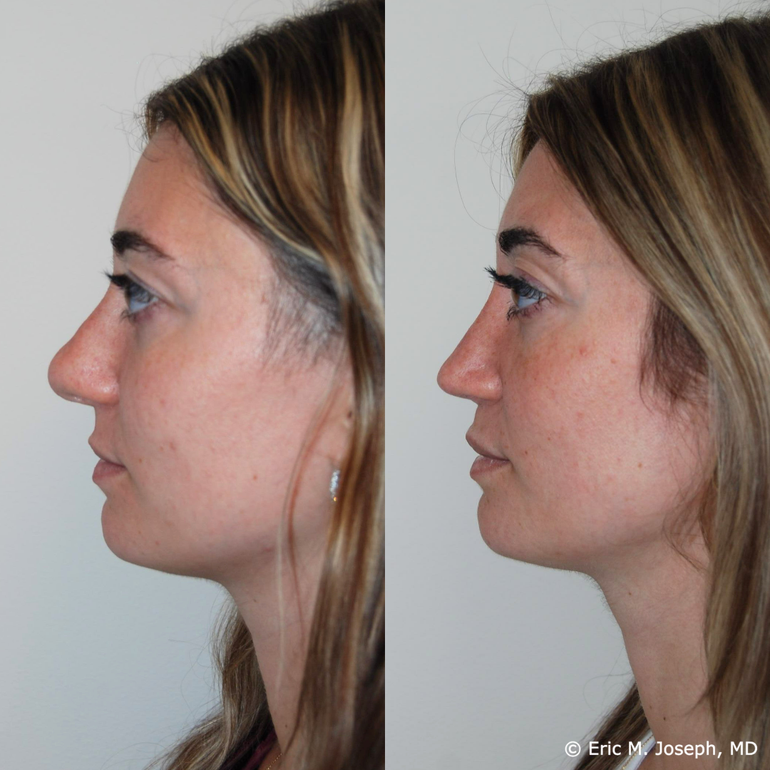 revision-rhinoplasty-nj-1024.png