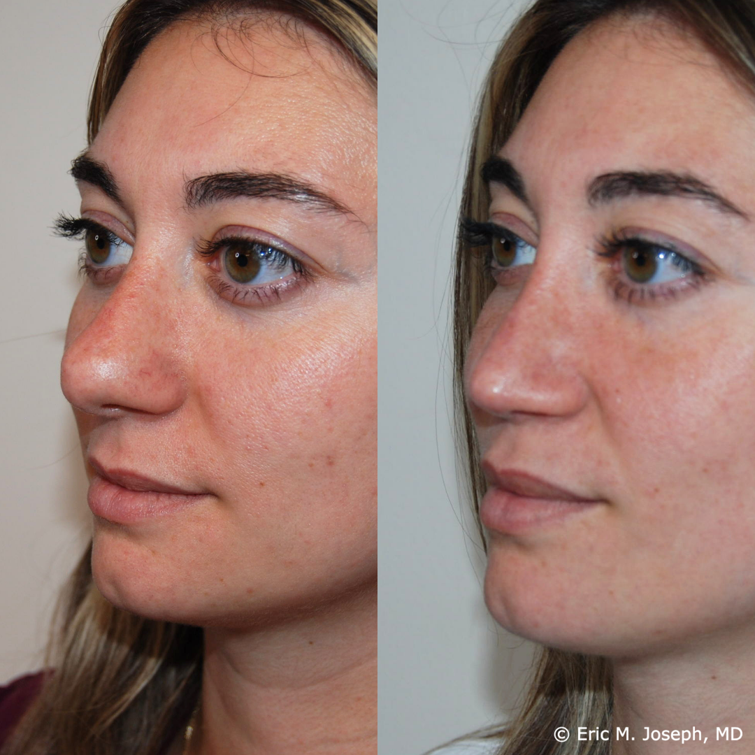 revision-rhinoplasty-nj-1025.png