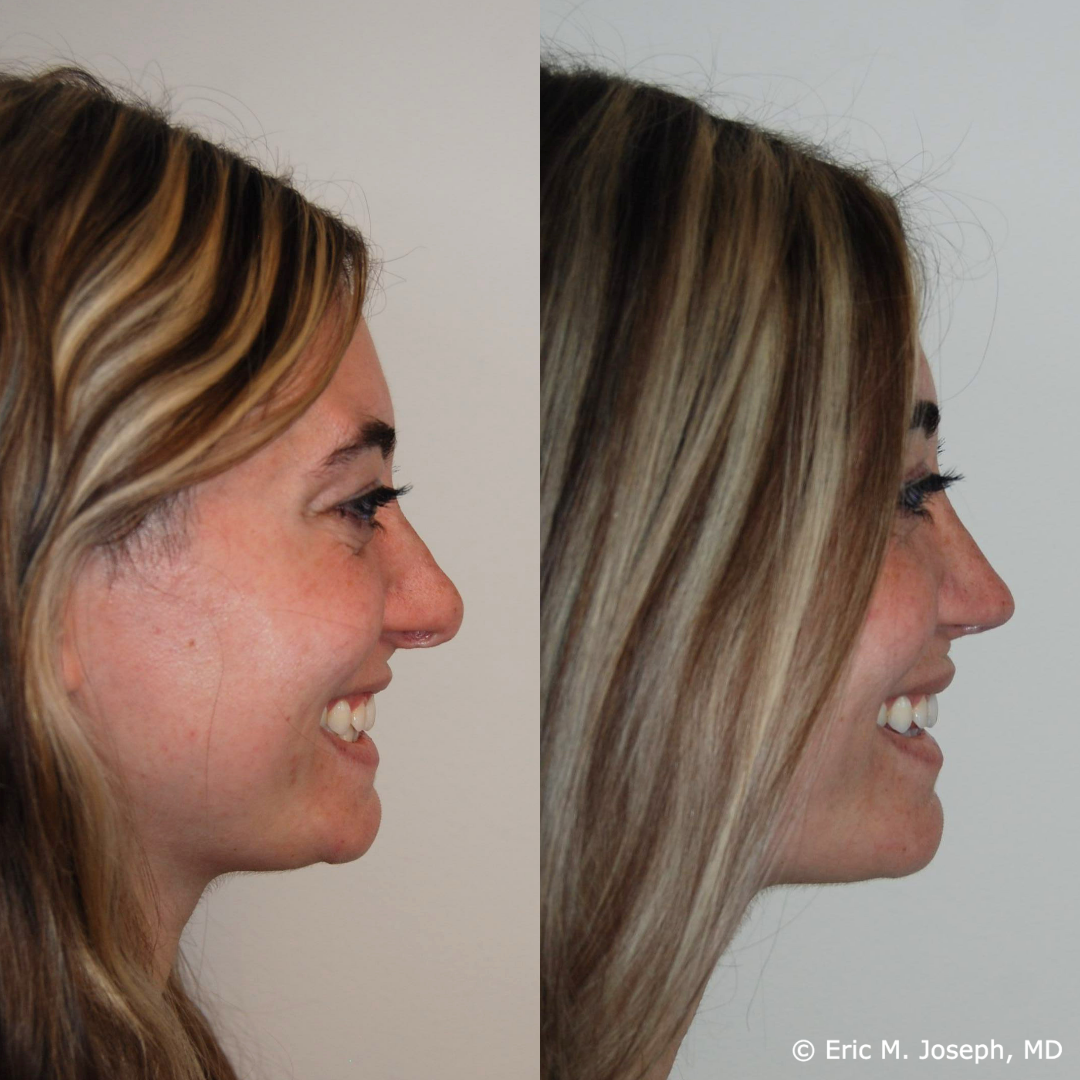 revision-rhinoplasty-nj-1026.png