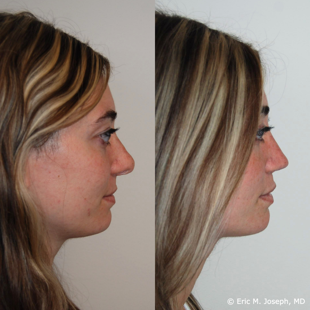 revision-rhinoplasty-nj-1027.png