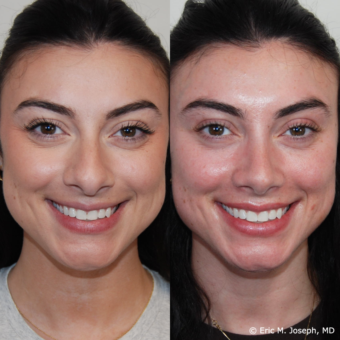 rhinoplasty-specialist-nj-0844.png