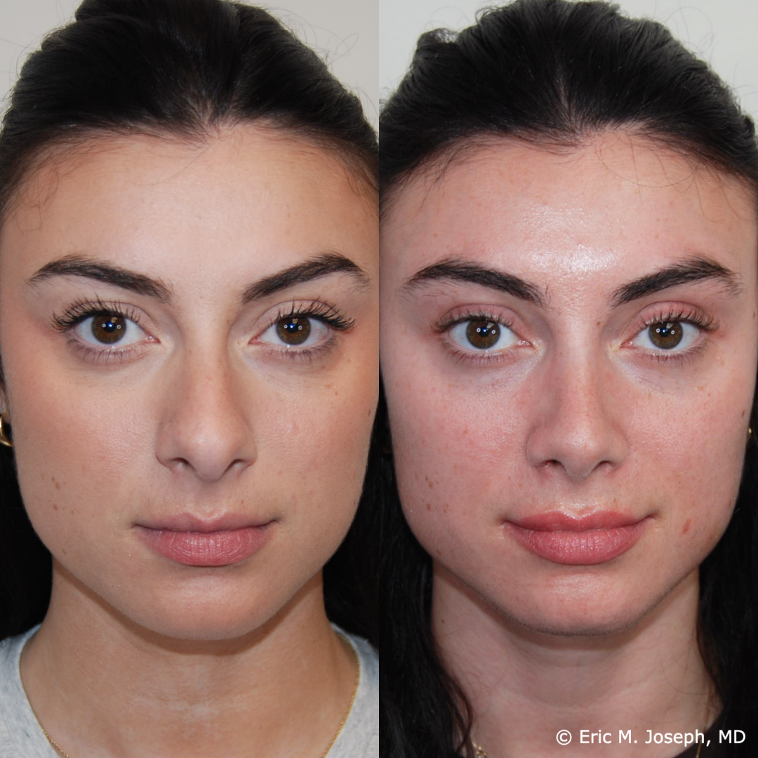 rhinoplasty-specialist-nj-0845.png