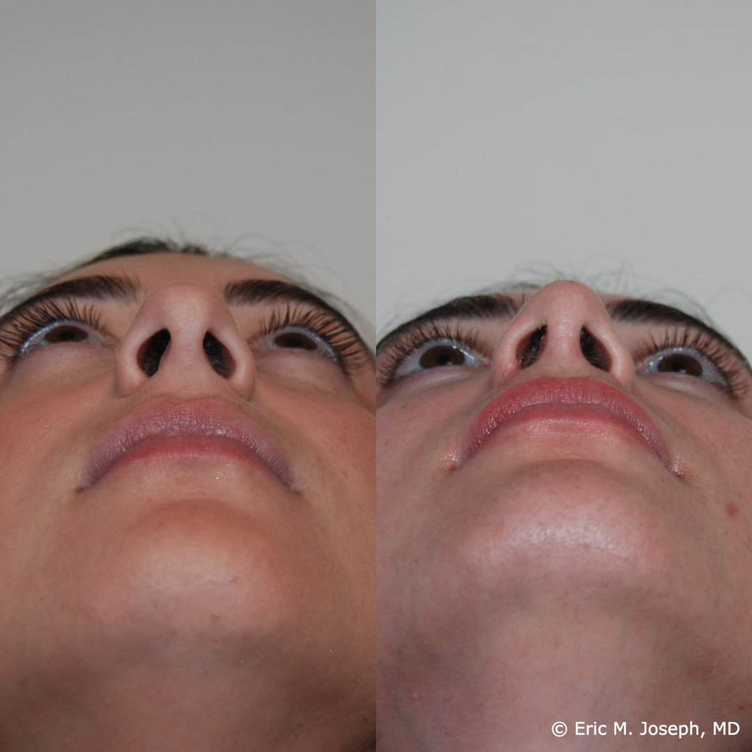 rhinoplasty-specialist-nj-0846.png