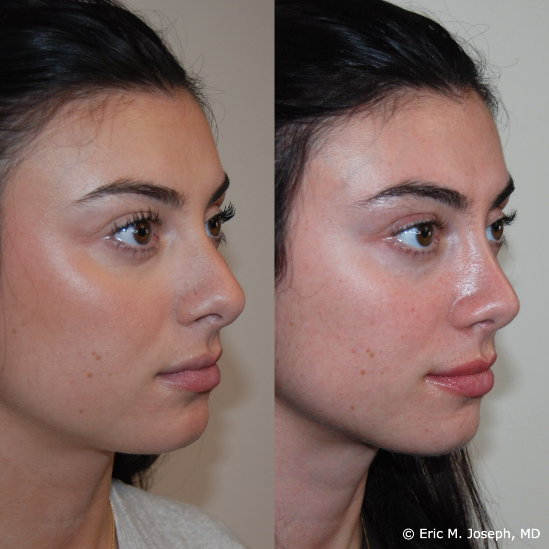 rhinoplasty-specialist-nj-0847.png