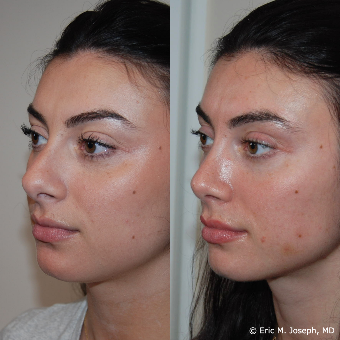 rhinoplasty-specialist-nj-0848.png