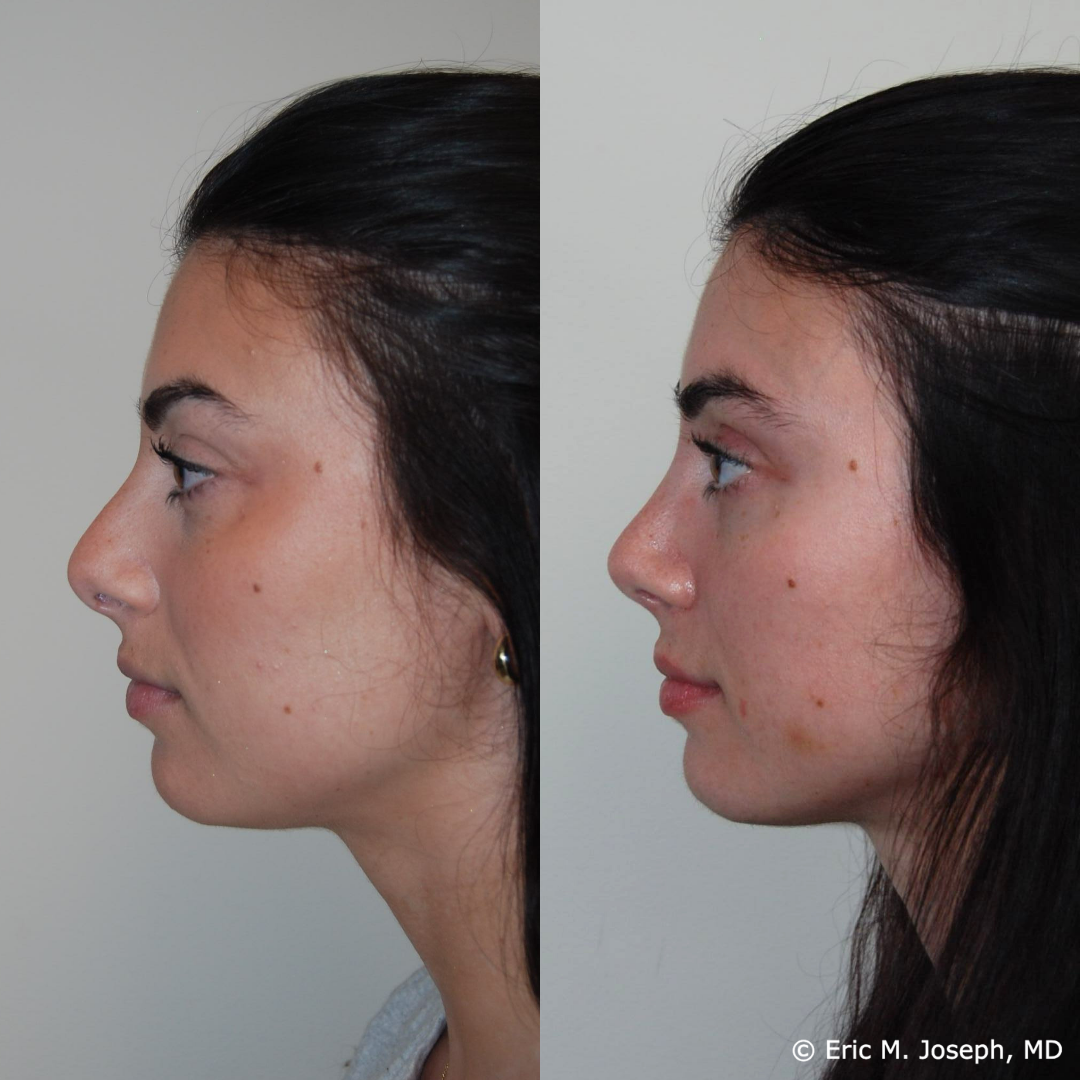 rhinoplasty-specialist-nj-0849.png
