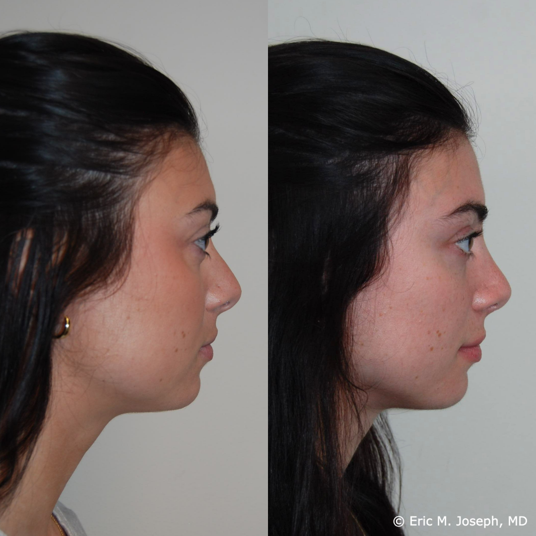 rhinoplasty-specialist-nj-0850.png