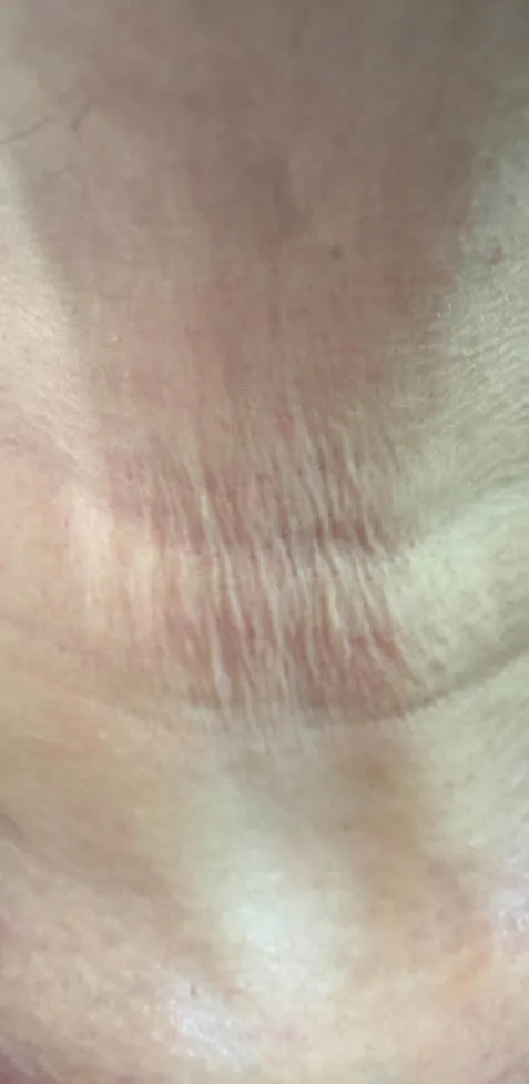 Before treatment