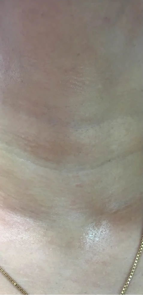 After treatment