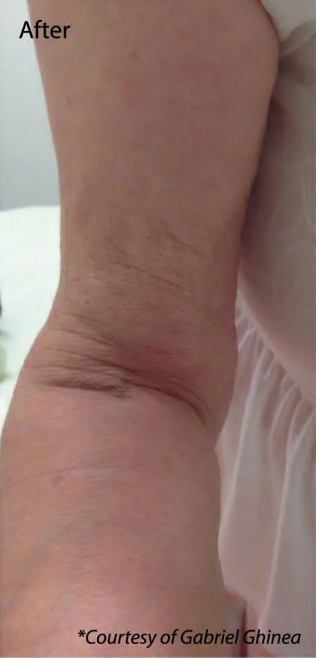 Profhilo arm after.jpg