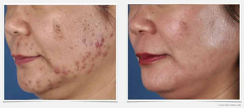 Conditions_Acne1_72.jpg