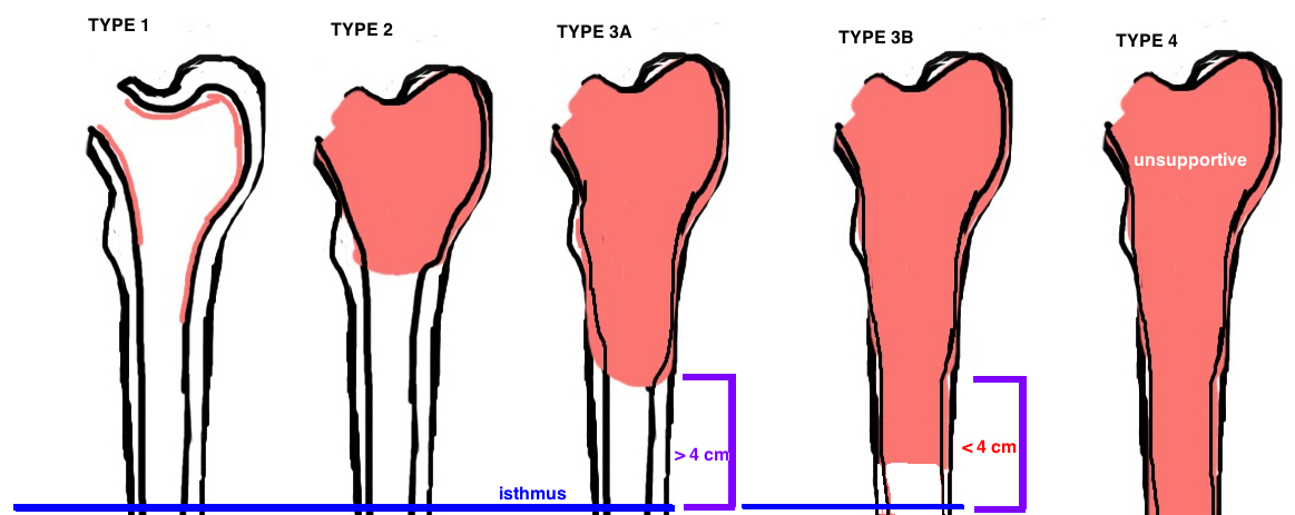 STEM: Press-Fit — Hip & Knee Book