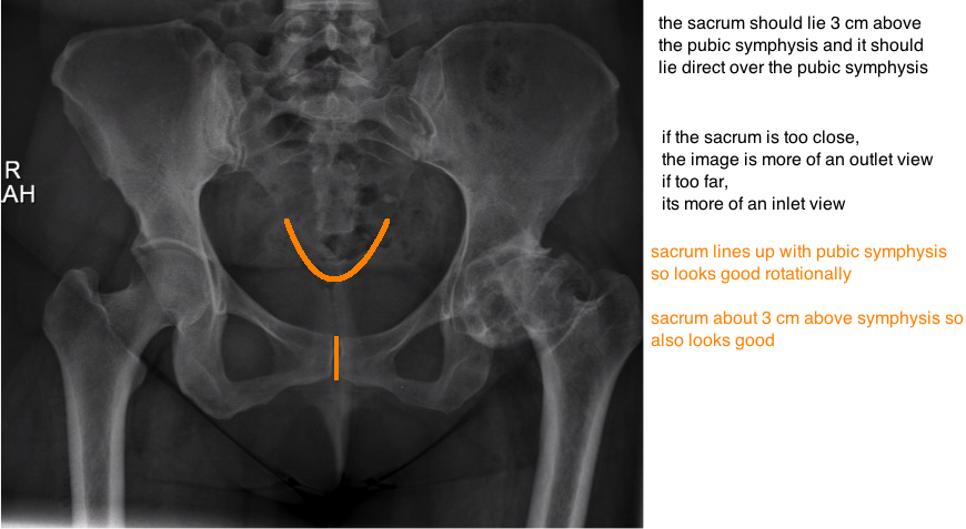 sacrum anatomy xray