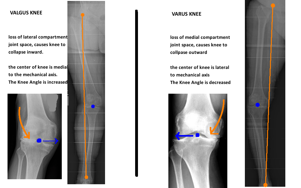 Valgus knee