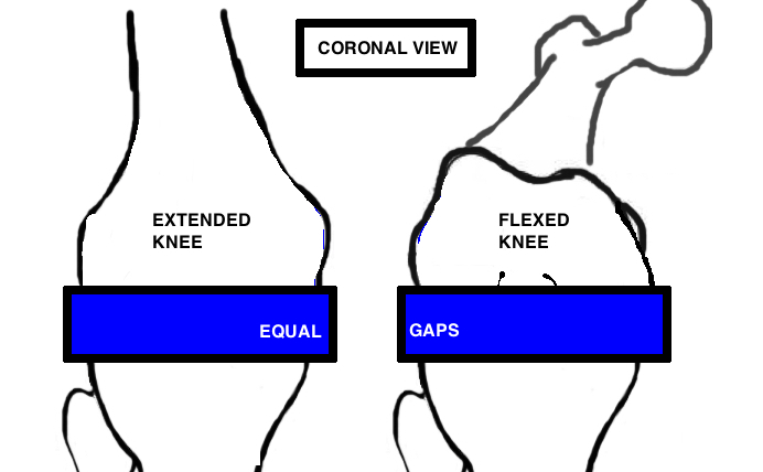 GAP BALANCE - SOFT TISSUE TENSION — Hip & Knee Book