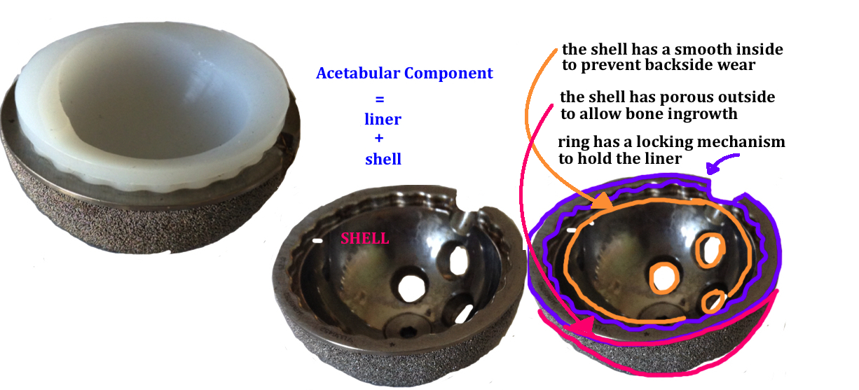 https://images.squarespace-cdn.com/content/v1/57dd4f14bebafbc0a139a6df/1492562728106-A0GOLFZ9CLEG6PH6YPHP/a+titanium+shell+and+polyethylene+liner+for+the++acetabular+implant