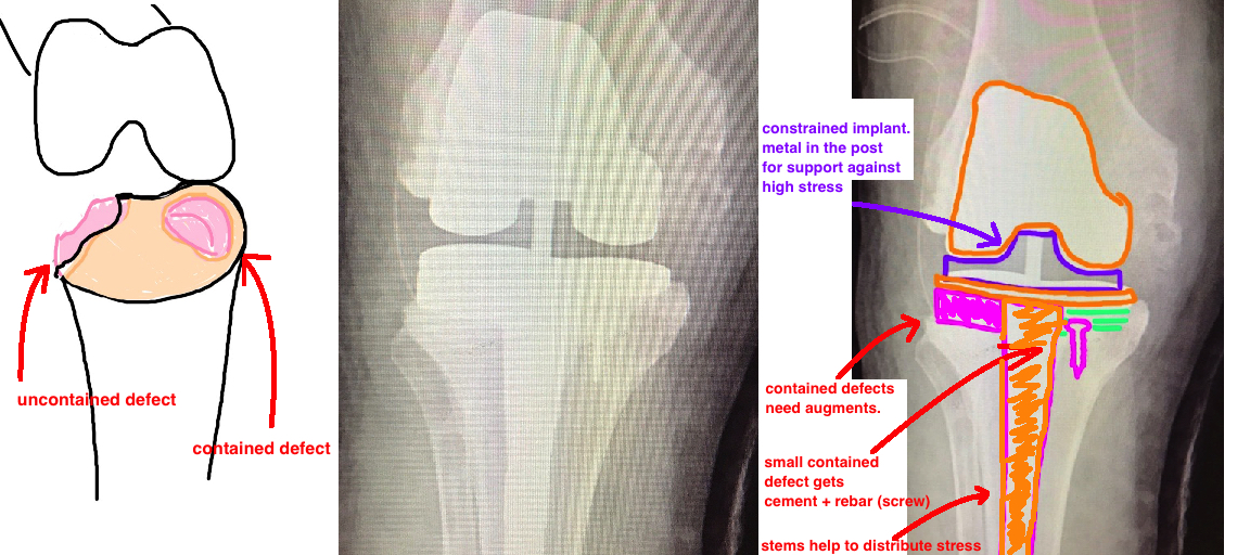 bone defects 1.jpg