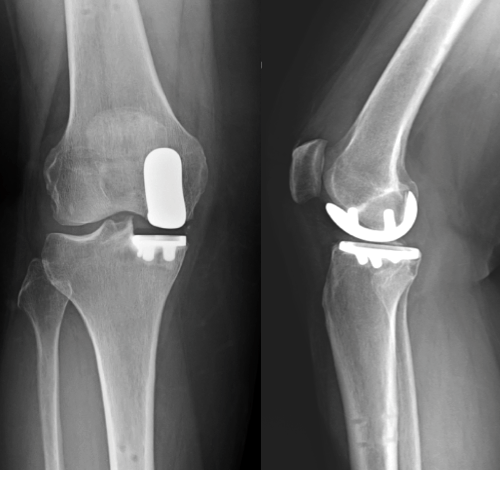 Stryker - MAKO partial knee