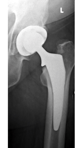 DePuy Actis