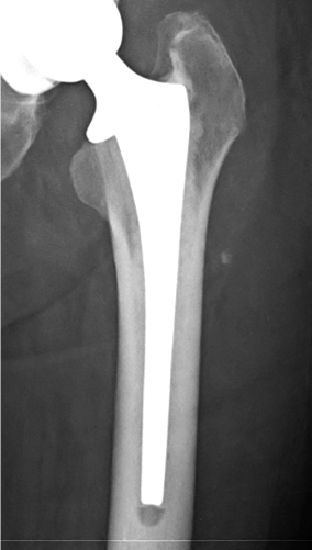 DePuy Summit (cement)