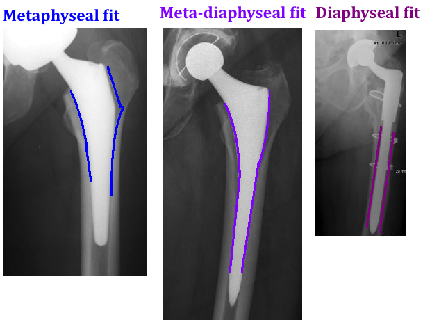 STEM: Press-Fit — Hip & Knee Book