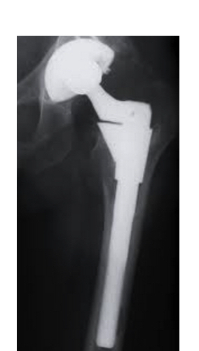 DePuy S-ROM