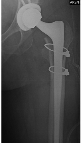 Smith&Nephew Redapt