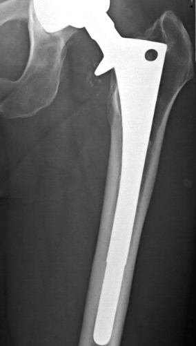 DePuy AML