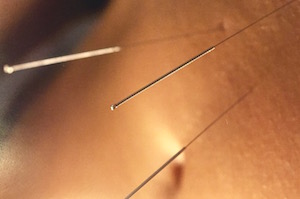 Rebalancing energy via acupuncture