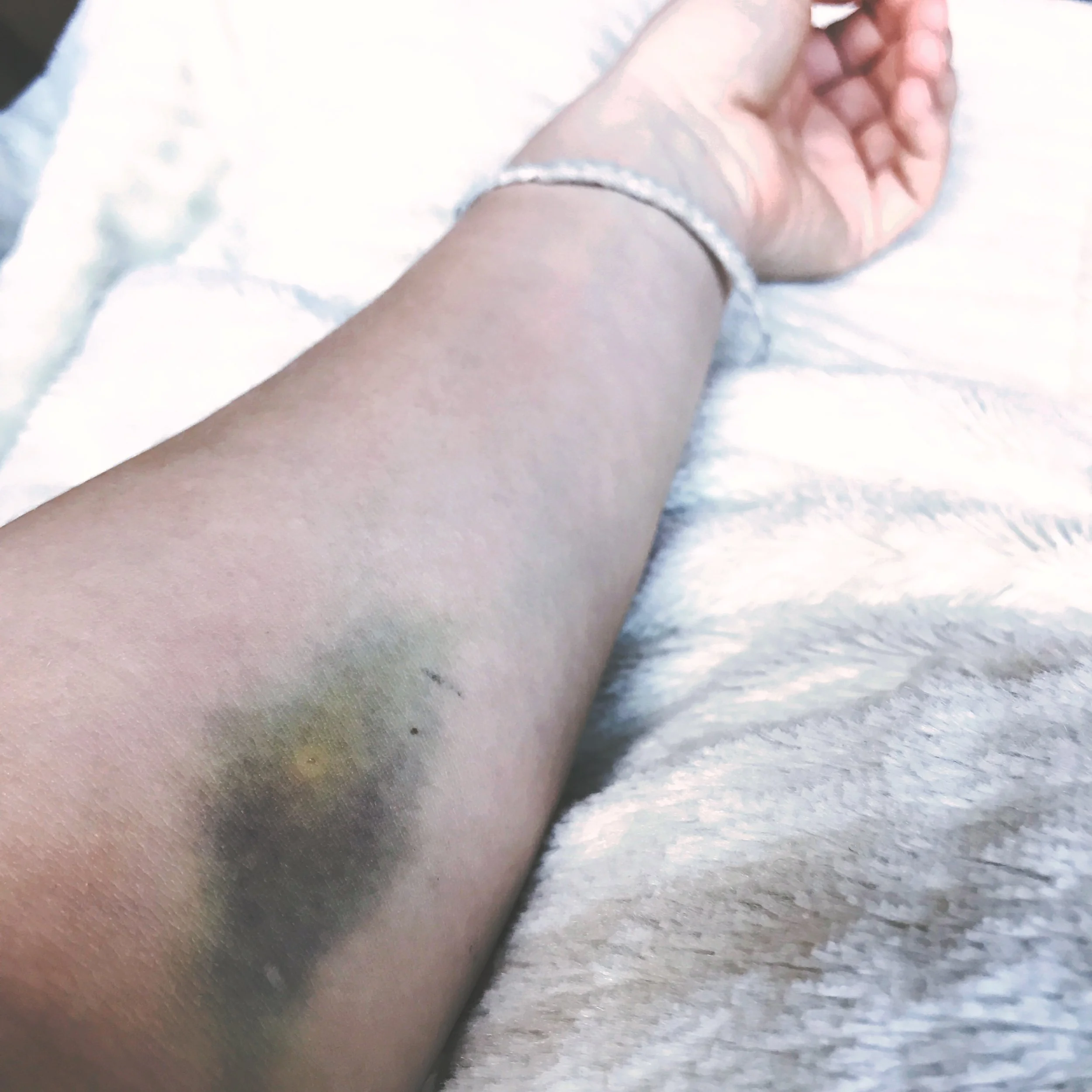 Me: half broken. A failed IV attempt. My stomach is a similar color, but I'll spare you.
