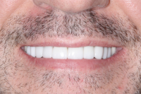 After Implant