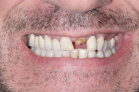 Before Implant