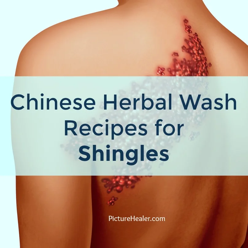 shingles Chinese herbal wash
