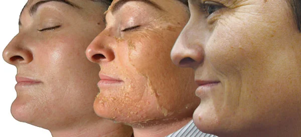 Perfection Lift Chemical Peel Full Face & Neck: $ 150 This exclusive blend of salicylic, lactic, resorcinol and retinol in a blend of peptides and plant derived stem cells creates “perfection” in addressing moderate to severe photo damage, deeper lines, and wrinkles as well as pigmentation disorders and acne.