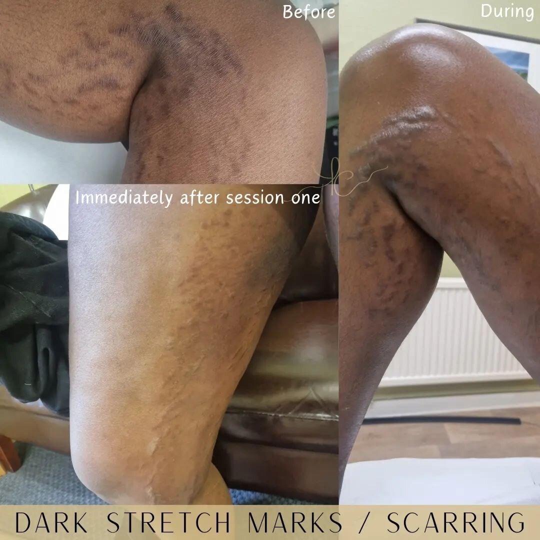Stretch mark camouflage on dark stretch marks 🤎  Immediately after the first session, not healed! Time taken - 3 hours! (Both legs)👹

Things to consider;

🤎 Will not be finished in one or two sessions 
🤎 The colour pigment used will not be a matc