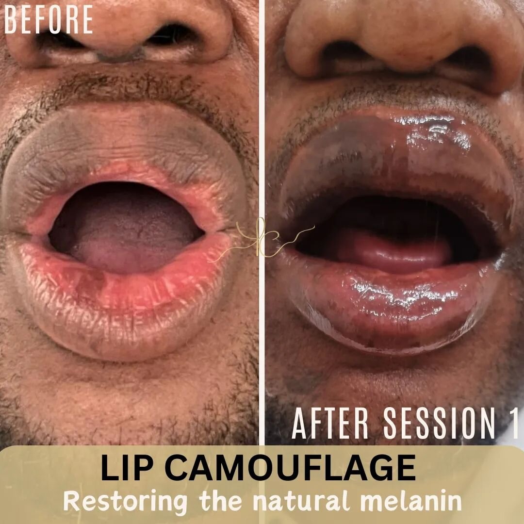 Restoring natural brown pigment in the lips from pigment loss, suspected vitiligo. This client had also been using creams prior to treatment 

Immediately after session  1. 
Multiple sessions required
⠀⠀⠀⠀⠀⠀⠀⠀⠀⠀⠀
⠀⠀⠀⠀⠀⠀⠀⠀

⠀⠀⠀⠀⠀⠀⠀⠀⠀⠀⠀
⠀⠀⠀⠀⠀⠀⠀⠀ 

#sca